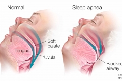 Medical-illustration-of-sleep-apnea